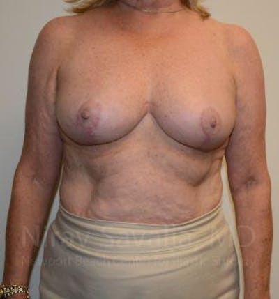 Case--1655501 | After Breast Lift Without Implants